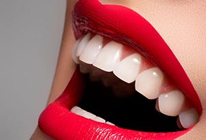 Отбеливание зубов при помощи системы Luma Cool