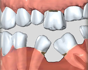 В какой срок после удаления зуба можно установить имплантат?