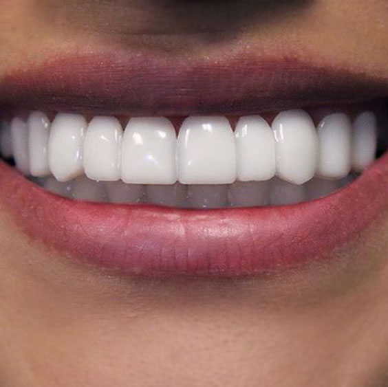 Что такое люминиры, стоит ли клеить их себе на зубы?