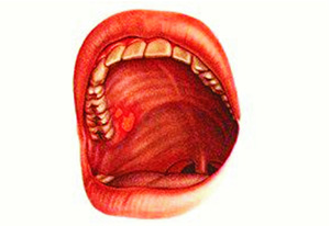 лечение воспаления полости рта