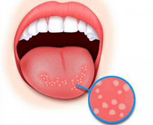 лечение воспаления полости рта