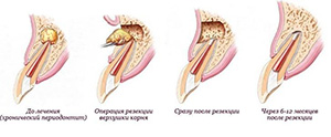 зубосохраняющие процедуры
