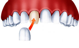 Микропротезирование в стоматологии спектрдент