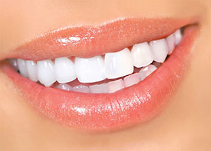 Отбеливание зубов в стоматологии на Авиамоторной