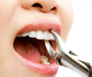 Удаление зубов (сложное и простое)