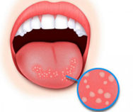 Лечение воспалений в полости рта